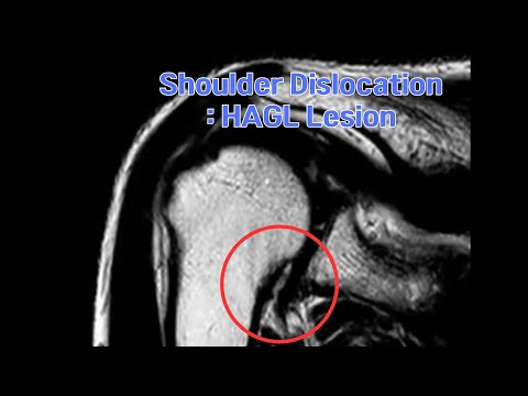 HAGL Lesion: Diagnosis, Risks, and Advanced Imaging Techniques; HAGL 병변: 진단, 주의점과 진보된 영상 진단 기술