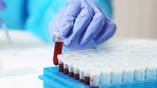 Blood test for early cancer detection shows promising results