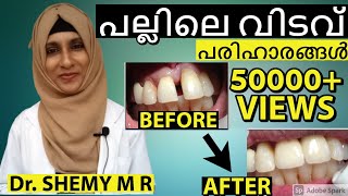 GAP in-between TEETH (2021):പല്ലിലെ വിടവ് (in Malayalam)| DIASTEMA Closure_Eng.Subs|| Dr. Shemy M R