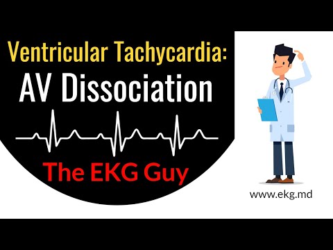 AV Dissociation in Ventricular Tachycardia - EKG / ECG Course | The EKG Guy - www.ekg.md
