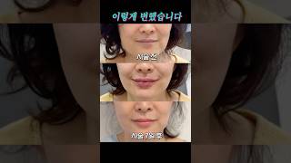 대부분 모르는 입술 필러의 심각한 부작용