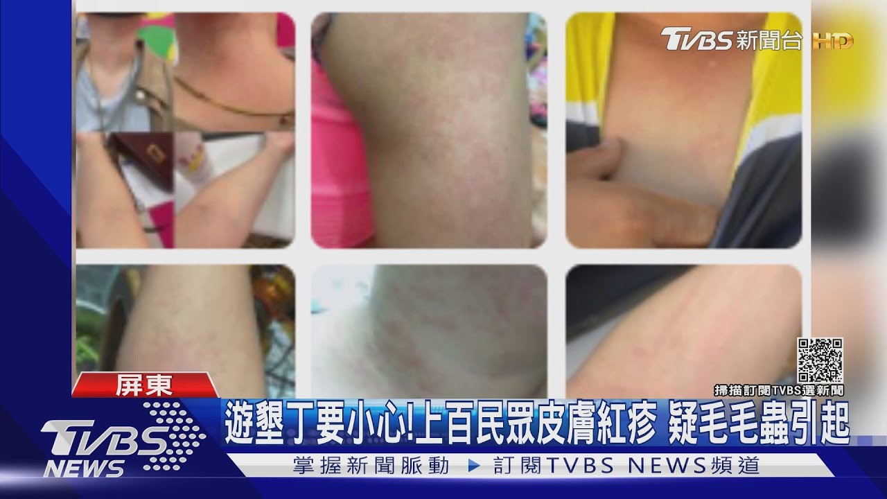 連假遊墾丁要小心!上百民眾皮膚紅疹 疑毛毛蟲引起