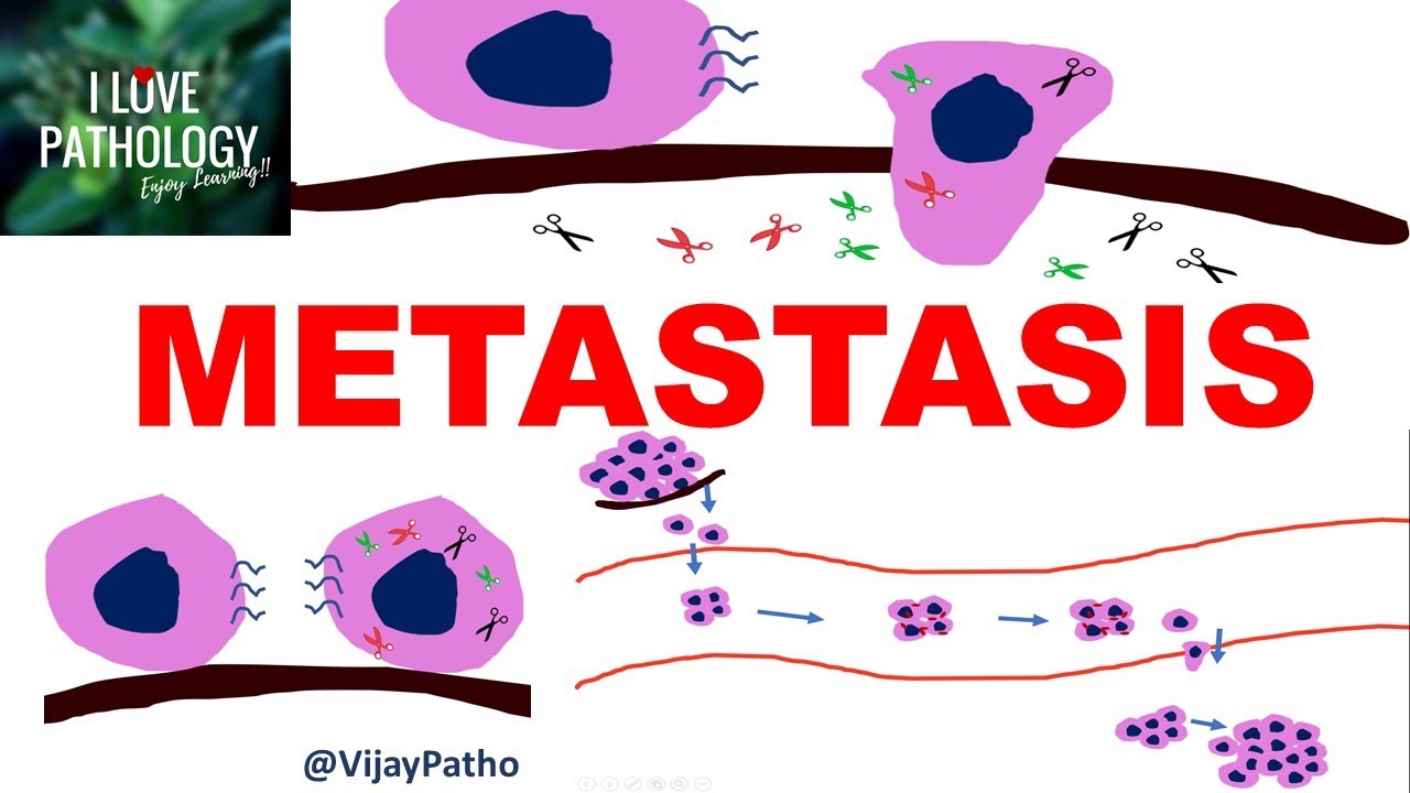 NEOPLASIA 8: INVASION AND METASTASIS; Mechanisms, Pathways of Spread