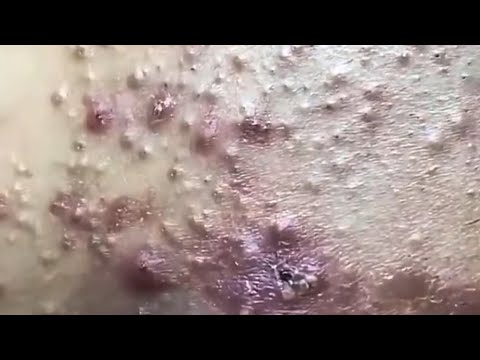 Blackheads & Whiteheads Satisfying Removal Acne and Pimple @08049