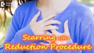 Will there be scarring after breast reduction? When will scars fade?- Dr. Srikanth V|Doctors