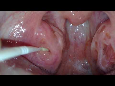 What is laryngeal papilloma