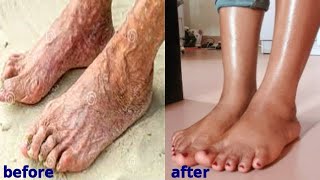 in 3 days remove wrinkles from foot get younger feet