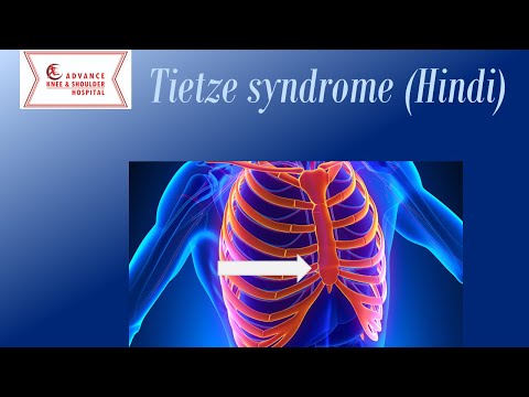 Teitze Syndrome hindi