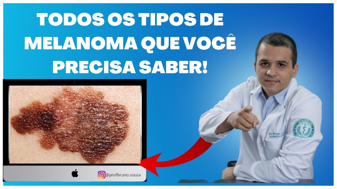Todos os tipos de melanoma maligno que você precisa saber!