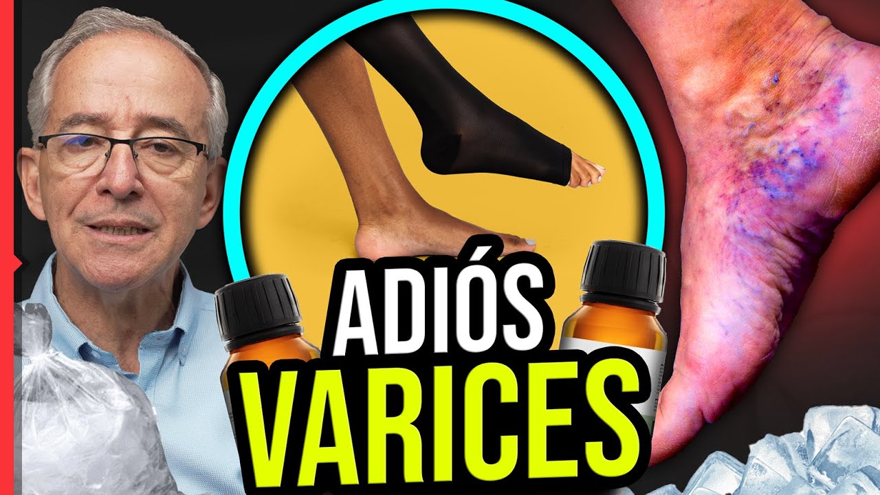 🔴 ADIÓS A LAS VARICES - Oswaldo Restrepo RSC