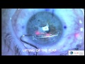 Femto Lasik by Dr. Alex Lange