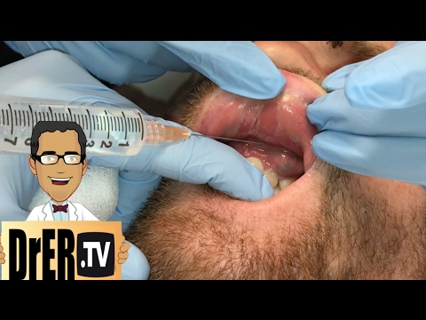 Mayroon bang isang lunas kuko nitrofunginom Fungus foot Video