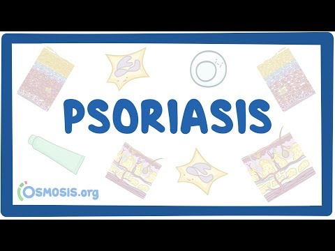 hogyan lehet gyógyítani a psoriasis vulgaris- t pikkelysömör kezelése prednizon