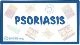 Astigmatizmus