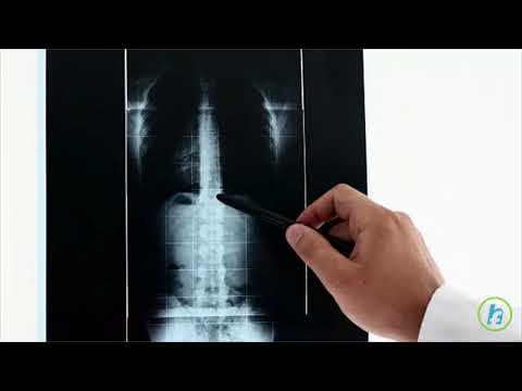 Artroza arcadelor coloanei vertebrale, Artroza – ce este, tratament si simptome | CENTROKINETIC