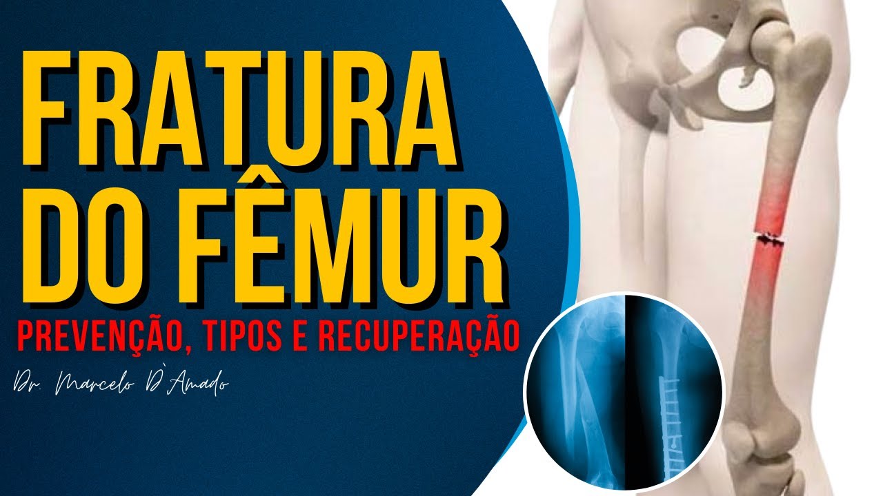 SOFREU UMA FRATURA NO FÊMUR? ENTENDA COMO PREVENIR, RECONHER E RECUPERAR