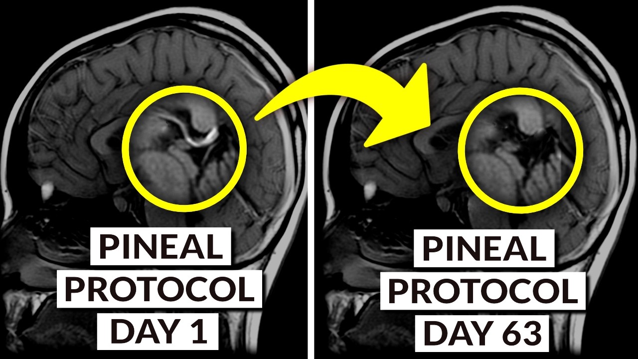 We Finally Know How To DECALCIFY The Pineal Gland