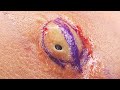 A SURPRISE Inside This Big Blackhead | CONTOUR DERMATOLOGY