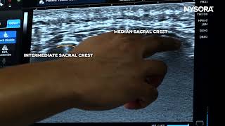 Ultrasound-Guided Caudal Epidural Injection NYSORA Medstudylab.com