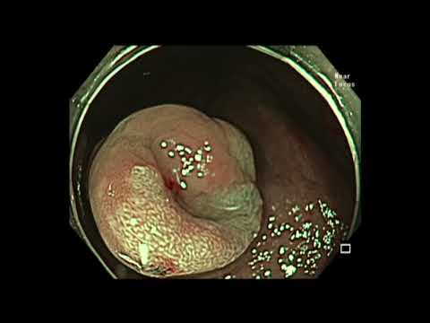 Colonoscopy: Appendicial Polyp -  examine to see its extent into appendix