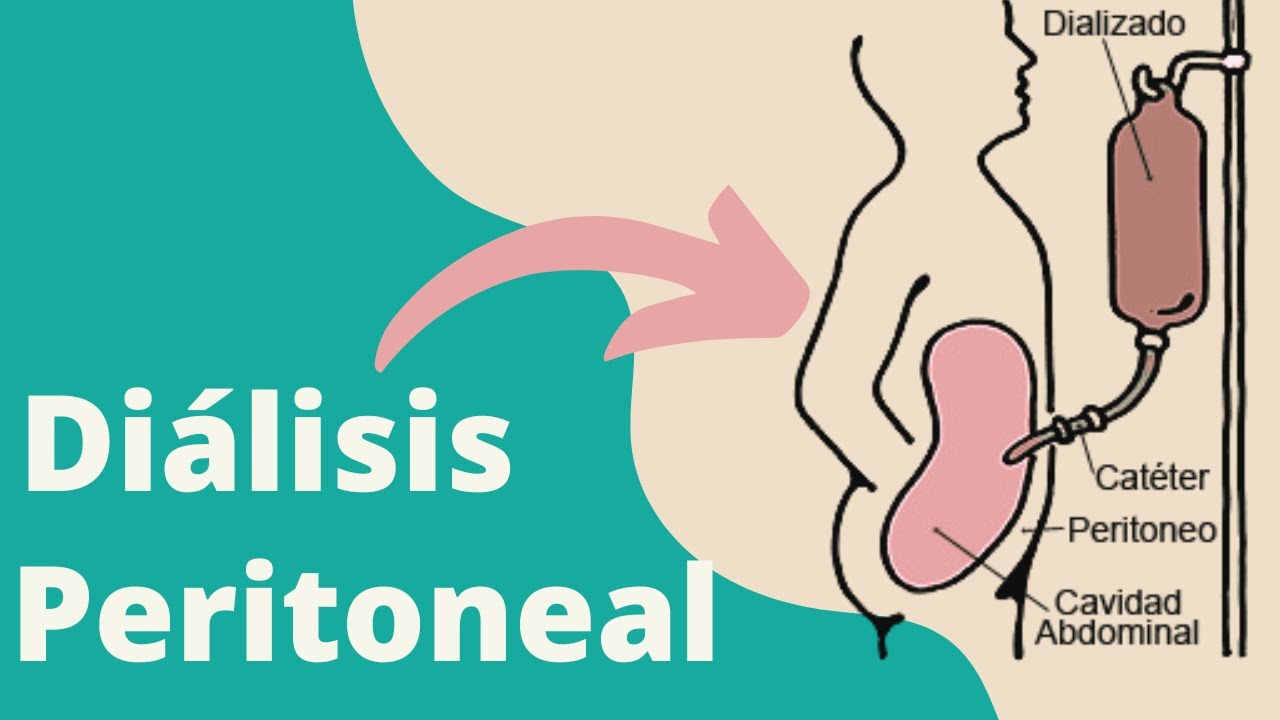 ¿Qué es la diálisis peritoneal?