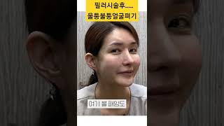 💉앞볼필러 (앞광대필러) 하기 전 🙋🏻‍♀️ 필수로 보셔야합니다❗