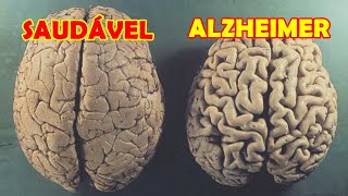 Dicas Simples para Prevenir Alzheimer