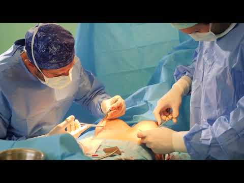 Breast Implant Stitching - Harley Breast