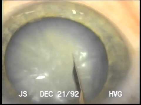 Conversion Of A Can-opener Capsulotomy Using Two-staged CCC