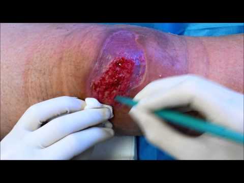 comment guerir un ulcere a la jambe