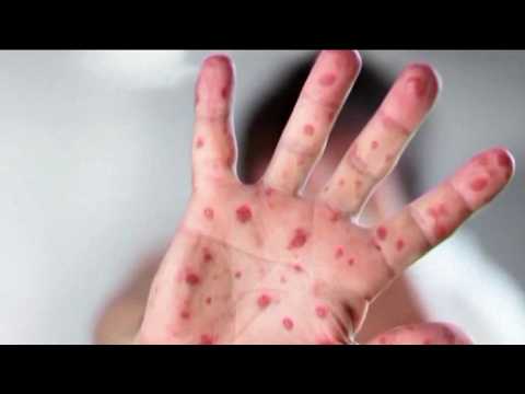Video: Shapiro, RFK Jr. clash over Pennsylvania measles deaths as cases hit 460