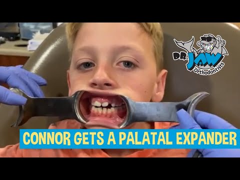 Connor Gets a Palatal Expander at Dr. JAW Orthodontists