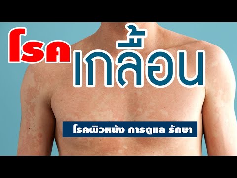 การเยียวยาชาวบ้านกลากระหว่างนิ้วมือ กลากน้ำมันมะคาเดเมีย
