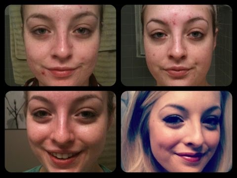 comment prendre roaccutane