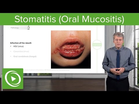 Stomatitis (Oral Mucositis) – Pediatric Infectious Diseases | Lecturio