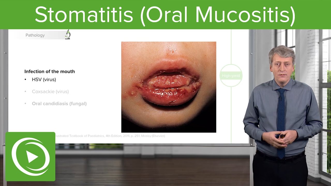 Stomatitis (Oral Mucositis) – Pediatric Infectious Diseases | Lecturio - YouTube