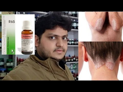 Homeopathic medicine for psoriasis explain
