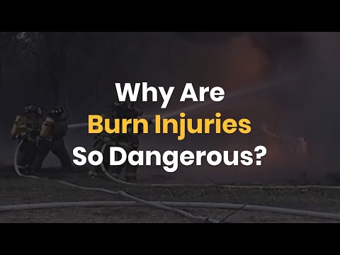 Why Are Des Plaines Burn Injuries So Dangerous?