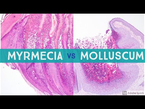 resorcinol condyloma hpv kezelés terhesség