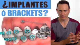 IMPLANTES o BRACKETS ¿Cuál va primero | ¡EL ORDEN SÍ IMPORTA! | Ortodoncia vs Implantes