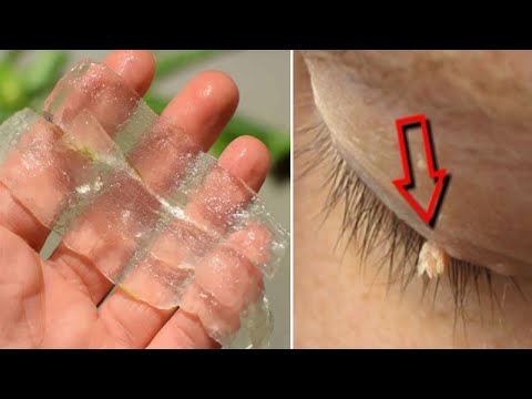 Zbulohet receta që largon kollaj fare lythat dhe pikat e zeza, është më e mira