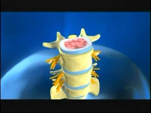 CTV National News Aug 11 2016 Promising New Spinal Cord Research