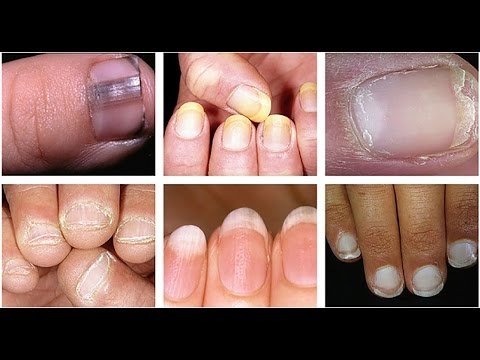 Poiché che crema con lazione di decolorazione di achroactive max Quale apparizione causata di lentiggini