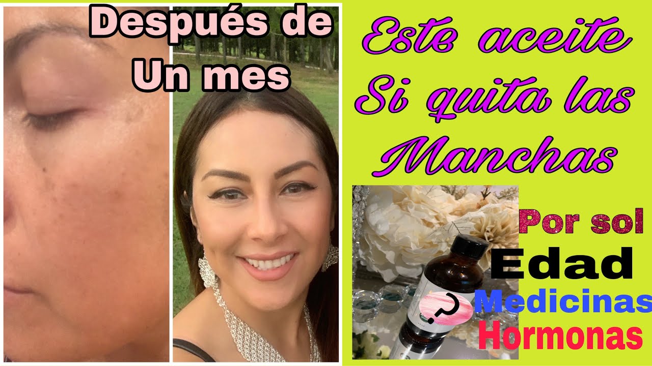 Watch El aceite que SI te quita las MANCHAS Por: SOL, HORMONAS, EDAD Y MEDICAMENTOS. 100% Comprobado. Now El aceite que SI te quita las MANCHAS Por: SOL, HORMONAS, EDAD Y MEDICAMENTOS. 100% Comprobado.