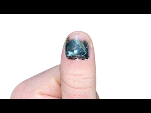 Finger nail healing process (TIME-LAPSE)