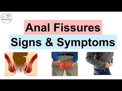 Anal Fissures Signs & Symptoms (& Why They Occur) | Acute vs Chronic Anal Fissures