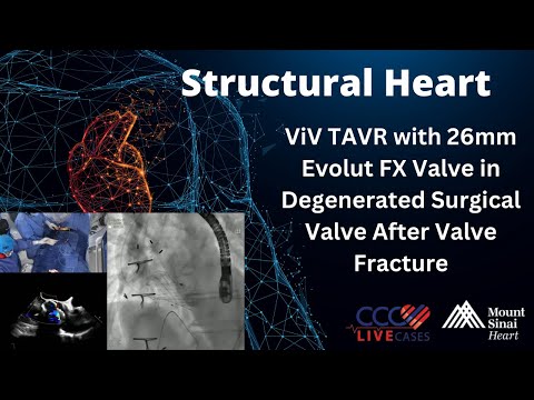 ViV TAVR with 26mm Evolut FX Valve inDegenerated Surgical Valve After Valve Fracture