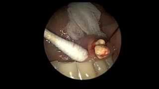 Large Salivary Gland Stone Removal Extraction Sialendoscopy