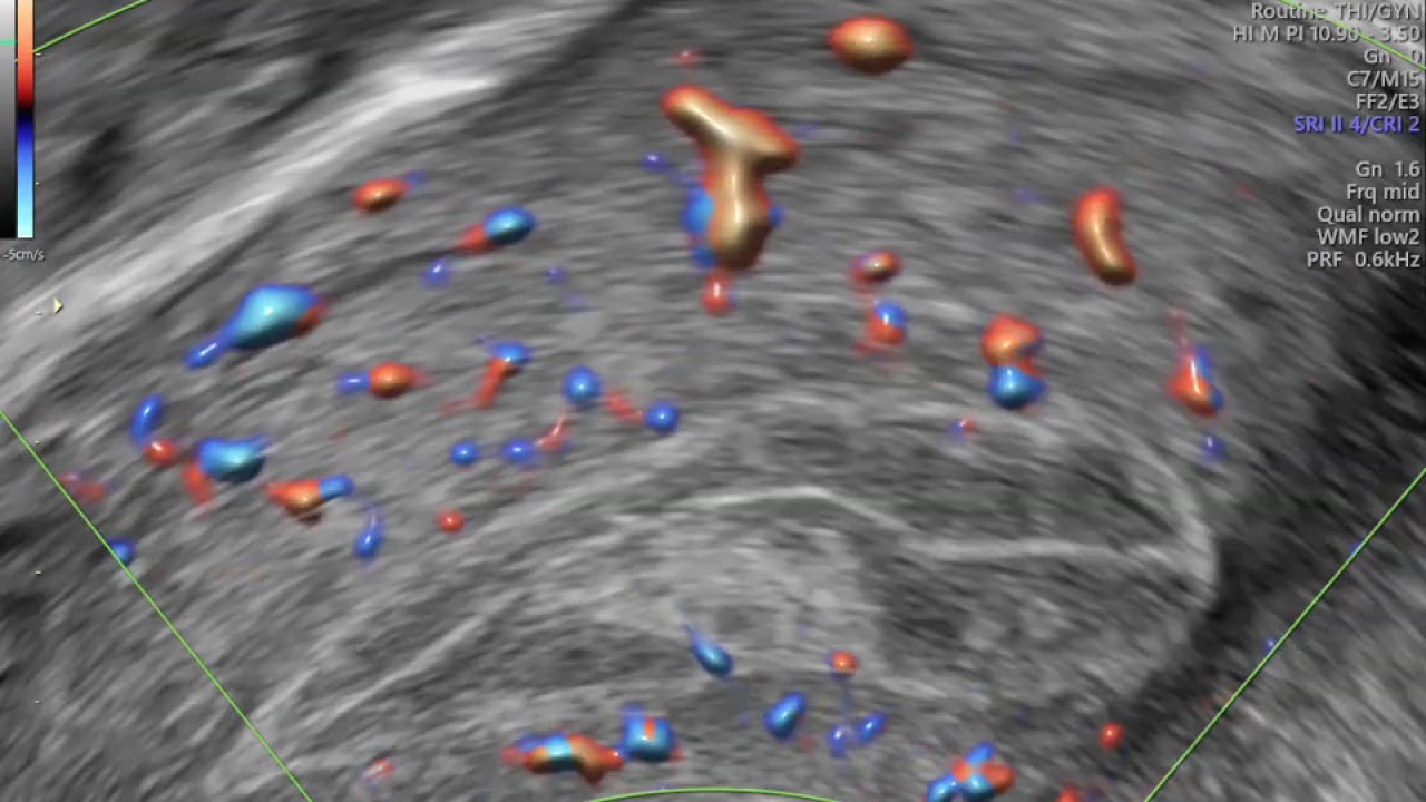POLIPO ENDOMETRIAL EM ULTRASSON TRANSVAGINAL