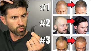 Top 3 Hair Loss Fixes EVERY GUY SHOULD KNOW ABOUT!